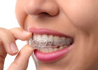 clear braces - invisalign