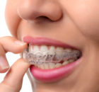 clear braces - invisalign