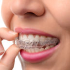 clear braces - invisalign