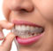 clear braces - invisalign