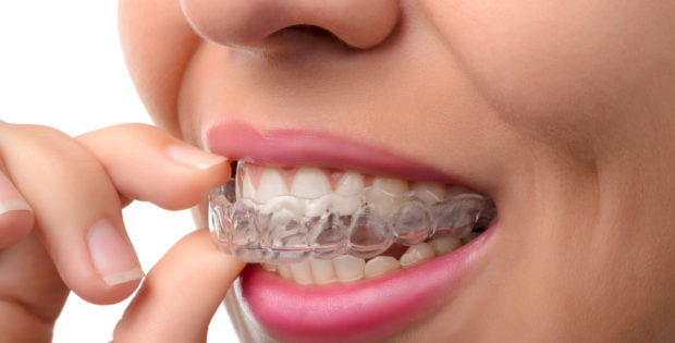 clear braces - invisalign